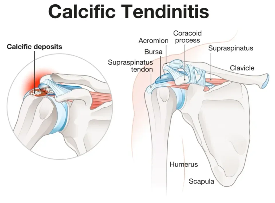 Calcific Tendinopathy: A Brief Overview